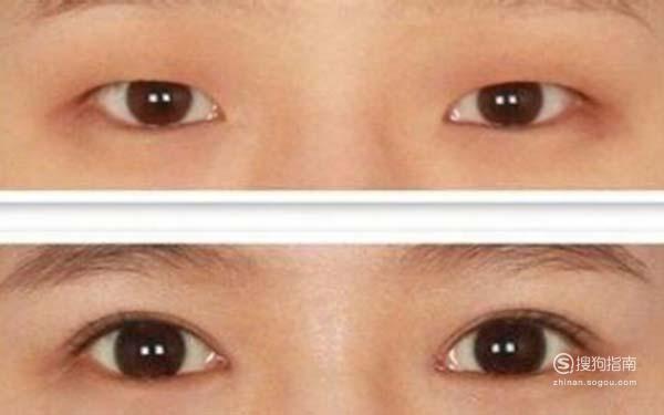 北京哪家医院做双眼皮修复好？